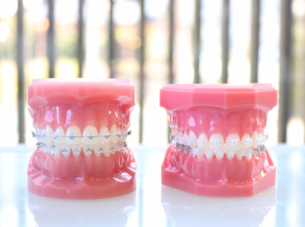 見えない矯正装置で