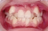 叢生(乱杭歯、八重歯、凸凹)