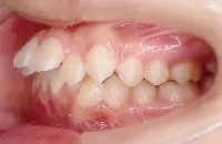 上顎前突(出っ歯)