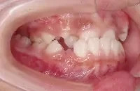 下顎前突(受け口)