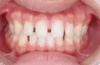 空隙歯列(すきっ歯)