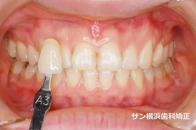 ホワイトニング前