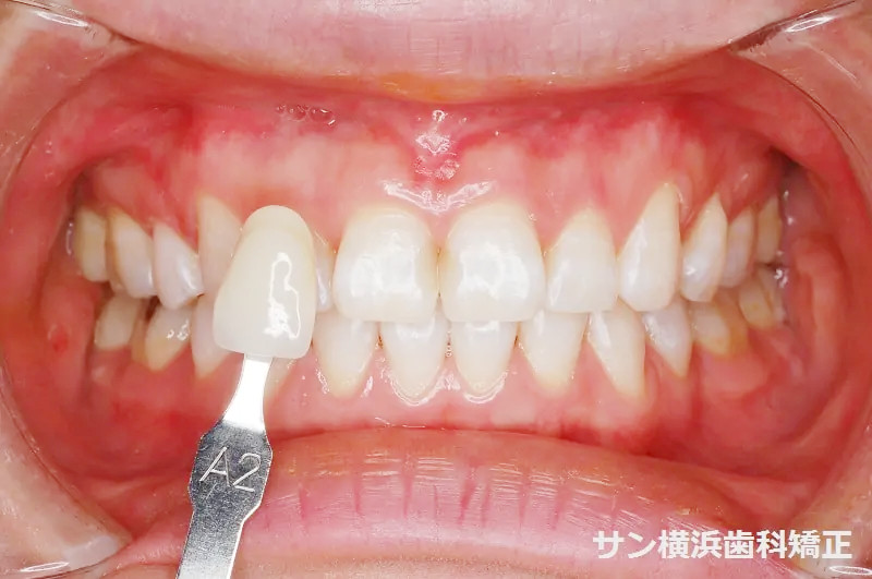 ホワイトニング後